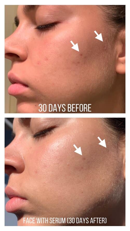 Blogger showing The Ordinary Niacinamide before and after