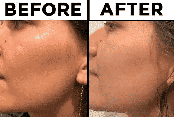 the ordinary hyaluronic acid before and after photo of Farrah Penn